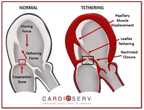 lv medical abbreviation|severe lv impairment.